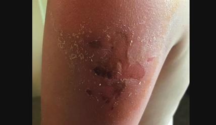 Health Canada testing Banana Boat sunscreen products as complaints mount | iNFOnews.ca