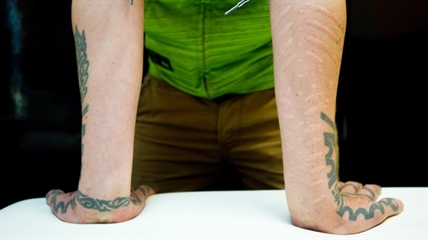 Scarification, an alternative to tattoos | iNFOnews.ca
