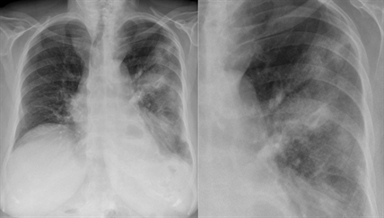 Fraser Health investigating outbreak of Legionnaires' disease in Surrey, B.C. | iNFOnews.ca