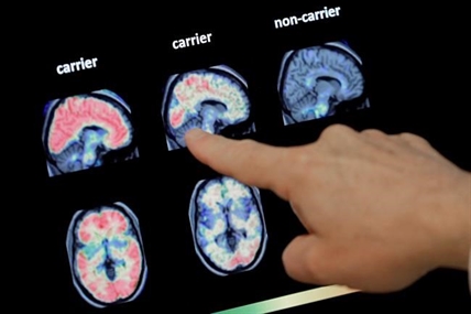 Drugs fail to slow decline in inherited Alzheimer's disease | iNFOnews.ca