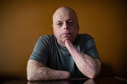 B.C. man prepares to be first to receive double-hand transplant in Canada | iNFOnews.ca