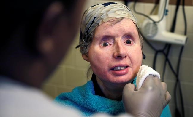 Chimp victim hospitalized with face-transplant complications | iNFOnews.ca