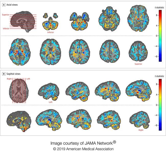 U.S. diplomats' brain scans show differences, add to Cuba mystery | iNFOnews.ca