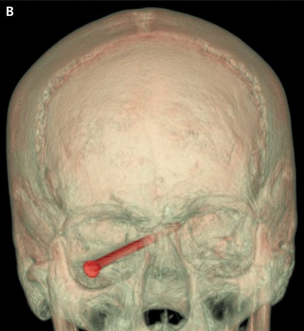 A 4-leaf clover in the weeds? Man escapes big harm after power trimmer sends nail into his eye | iNFOnews.ca