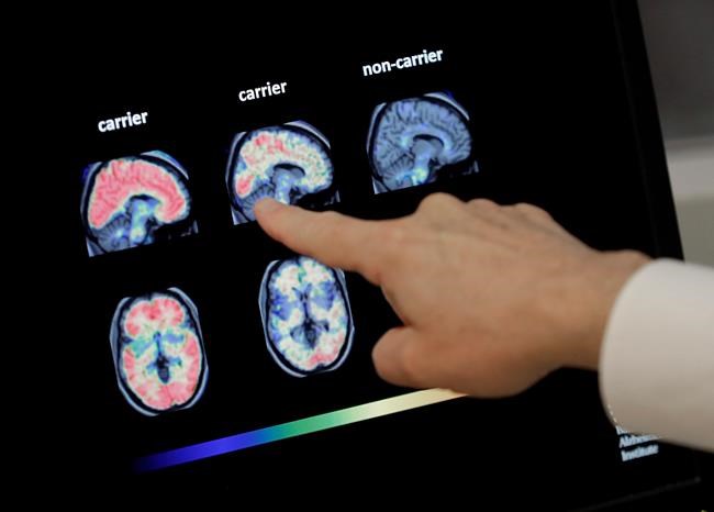 Medicare coverage for Alzheimer brain scans in question | iNFOnews.ca Medicare coverage for Alzheimer brain scans in question | iNFOnews.ca
