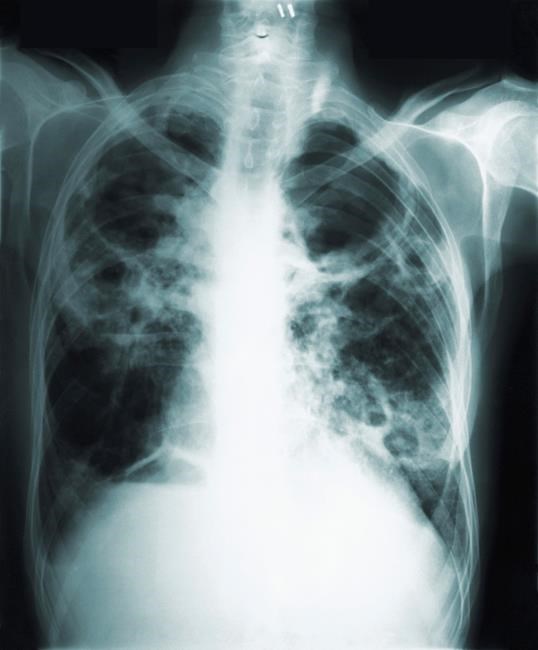 Vaccine shows promise for preventing active TB disease | iNFOnews.ca