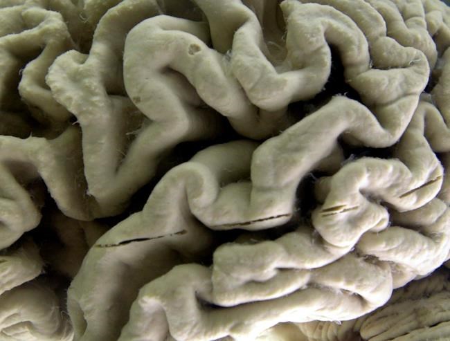 Late-life high blood pressure may harm the brain, study says | iNFOnews.ca