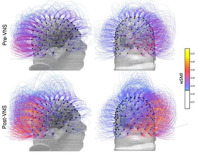 Treatment restores signs of awareness in brain-injured man | iNFOnews.ca