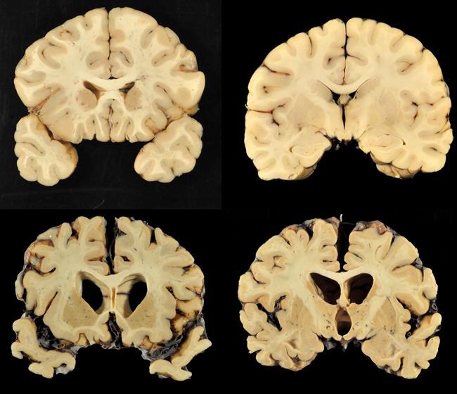 Brain disease seen in most football players in large report | iNFOnews.ca