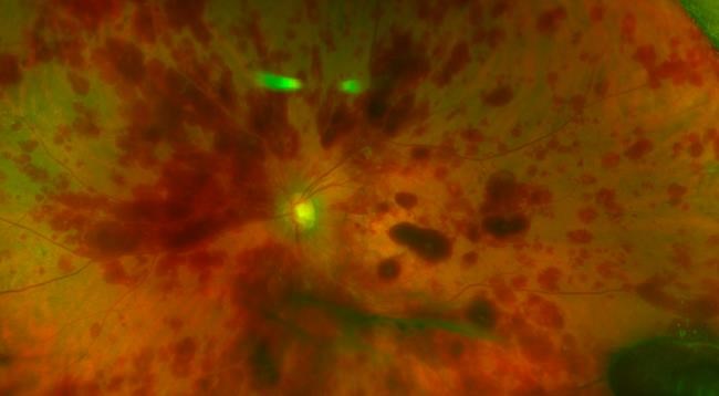 Doctors say unproven stem cell treatment blinded 3 women | iNFOnews.ca