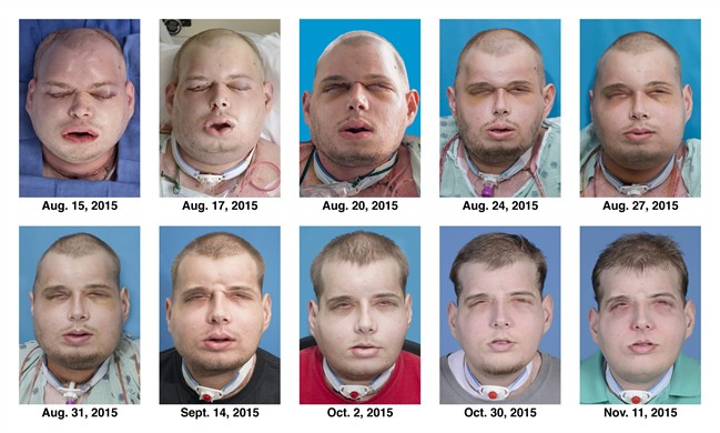 Transplant gives new face, scalp to burned volunteer firefighter, will restore normal vision | iNFOnews.ca CP35344021