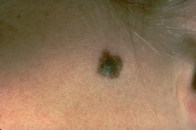 Skin cancer drop in Northeast bucks rising rates elsewhere | iNFOnews.ca Skin cancer drop in Northeast bucks rising rates elsewhere | iNFOnews.ca