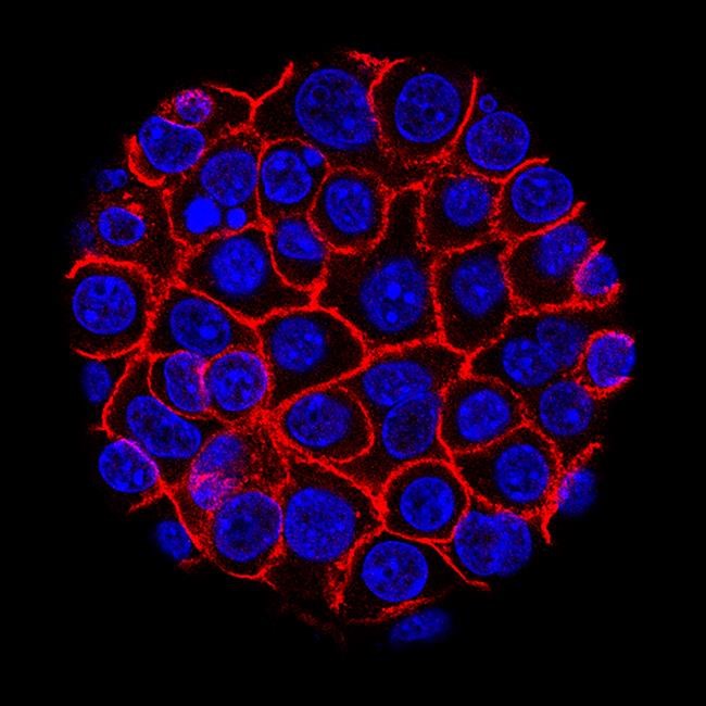 Study finds rare gain for tough-to-treat pancreatic cancer | iNFOnews.ca