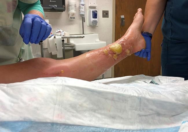 Poison parsnip causes severe burns, blisters on woman's legs | iNFOnews.ca