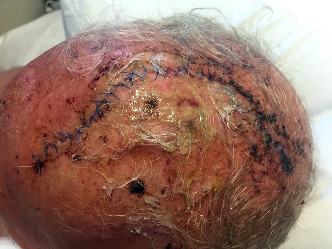 Grizzly bites, claws hunter; man's head got worst of it | iNFOnews.ca Grizzly bites, claws hunter; man's head got worst of it | iNFOnews.ca