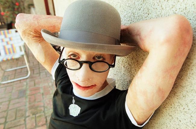 Dave Dave, who was set afire as boy, died of natural causes | iNFOnews.ca CP56971090