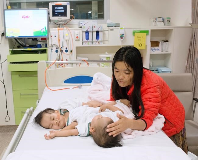Surgeons in Australia separate conjoined girls from Bhutan | iNFOnews.ca Surgeons in Australia separate conjoined girls from Bhutan | iNFOnews.ca