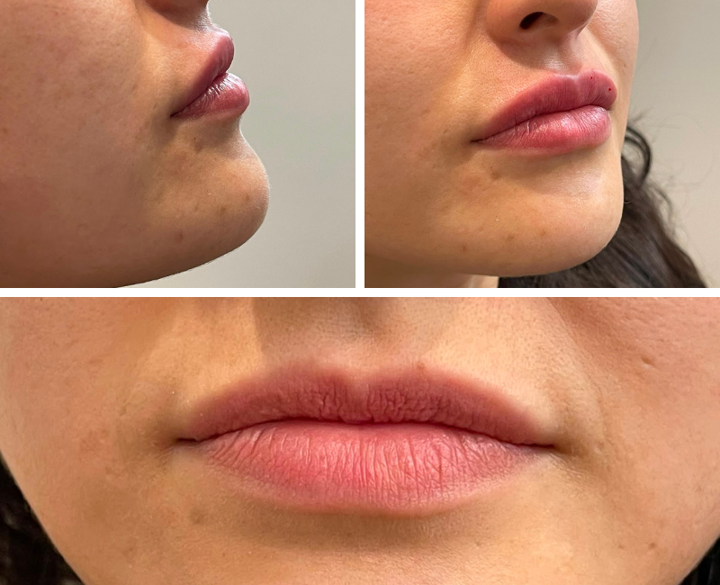 Subtlety: The New Trend in Dermal Fillers | iNFOnews.ca