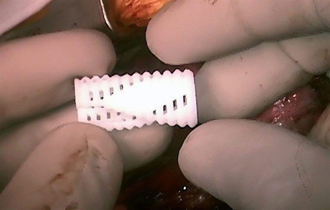 Made-to-order airway tubes save 3 boys, show promise of 3-D printing to customize medical care | iNFOnews.ca CP32896376
