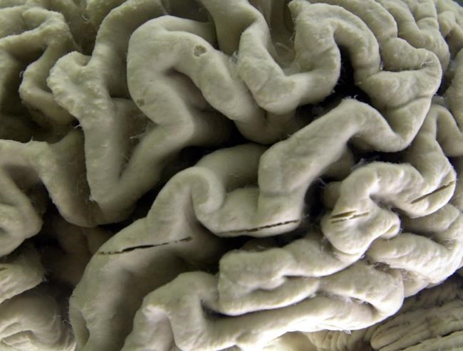 Hints that lifestyle changes might guard against dementia | iNFOnews.ca