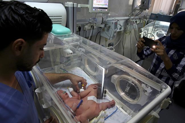 Doctor: Conjoined twins born in Gaza will need care abroad | iNFOnews.ca Doctor: Conjoined twins born in Gaza will need care abroad | iNFOnews.ca