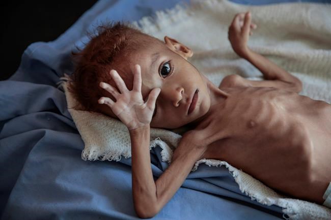 Aid group: 85,000 children may have died of hunger in Yemen | iNFOnews.ca