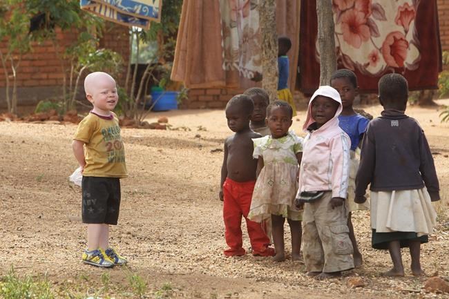 Malawi sees surge in attacks on albinos; victims speak out | iNFOnews.ca Malawi sees surge in attacks on albinos; victims speak out | iNFOnews.ca