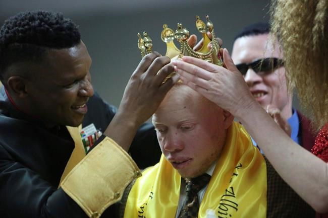Albinism pageant in Zimbabwe joyfully breaks down prejudice | iNFOnews.ca