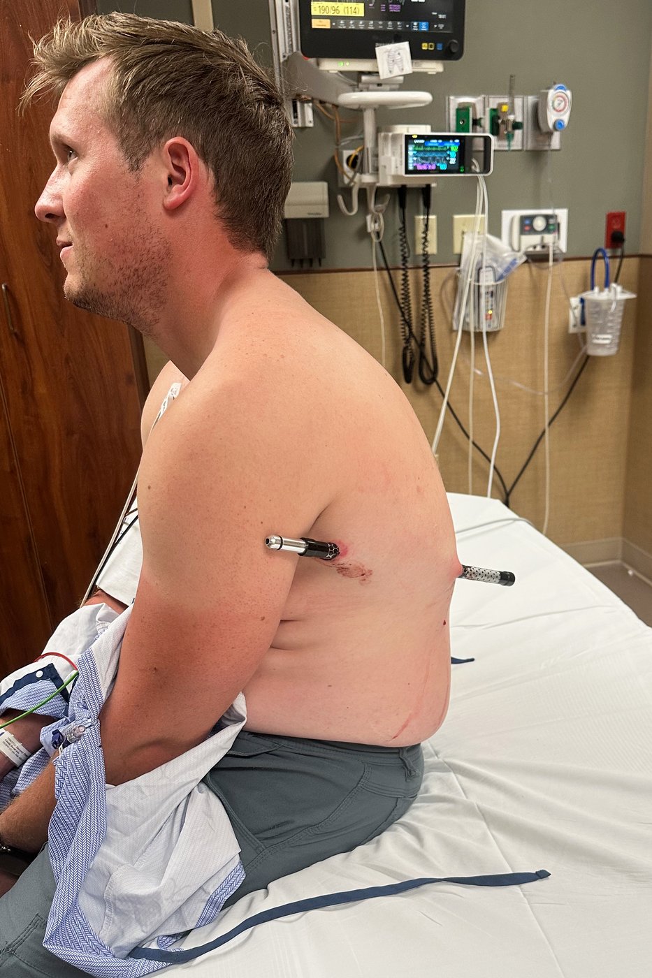 Montana man hikes out of the mountains to get help after he was impaled by a trekking pole | iNFOnews.ca Montana man hikes out of the mountains to get help after he was impaled by a trekking pole | iNFOnews.ca