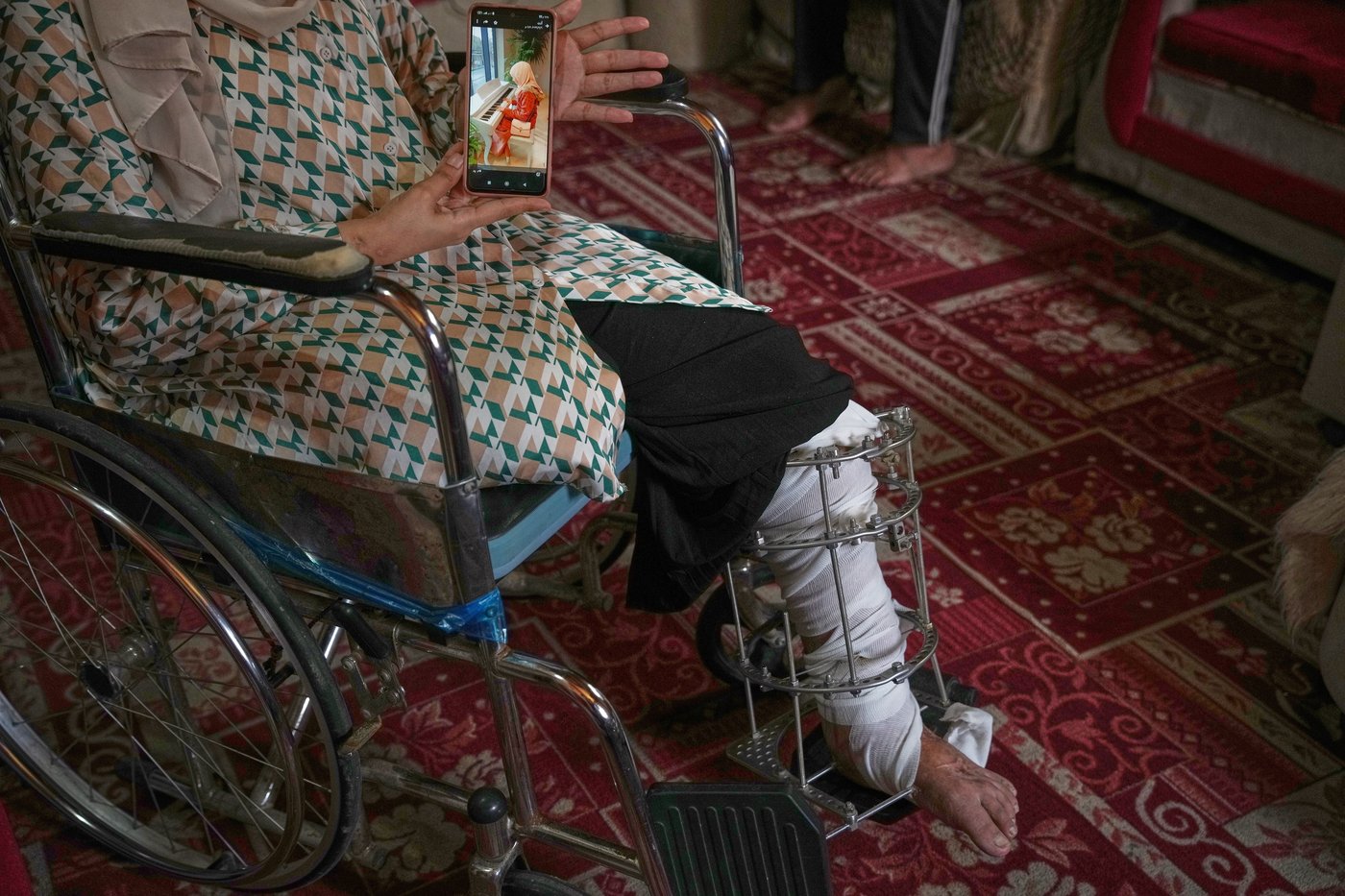 Gaza amputees struggle to rebuild lives as the enclave faces shortages of prosthetic limbs | iNFOnews.ca