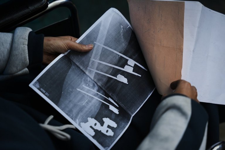 A bullet shattered her knee. Now a Gaza teen's chances of walking depend on Rafah border crossing | iNFOnews.ca