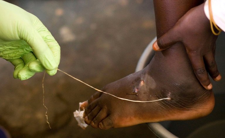 World creeps closer to eradicating human Guinea worm cases, with just 10 last year: Carter Center | iNFOnews.ca