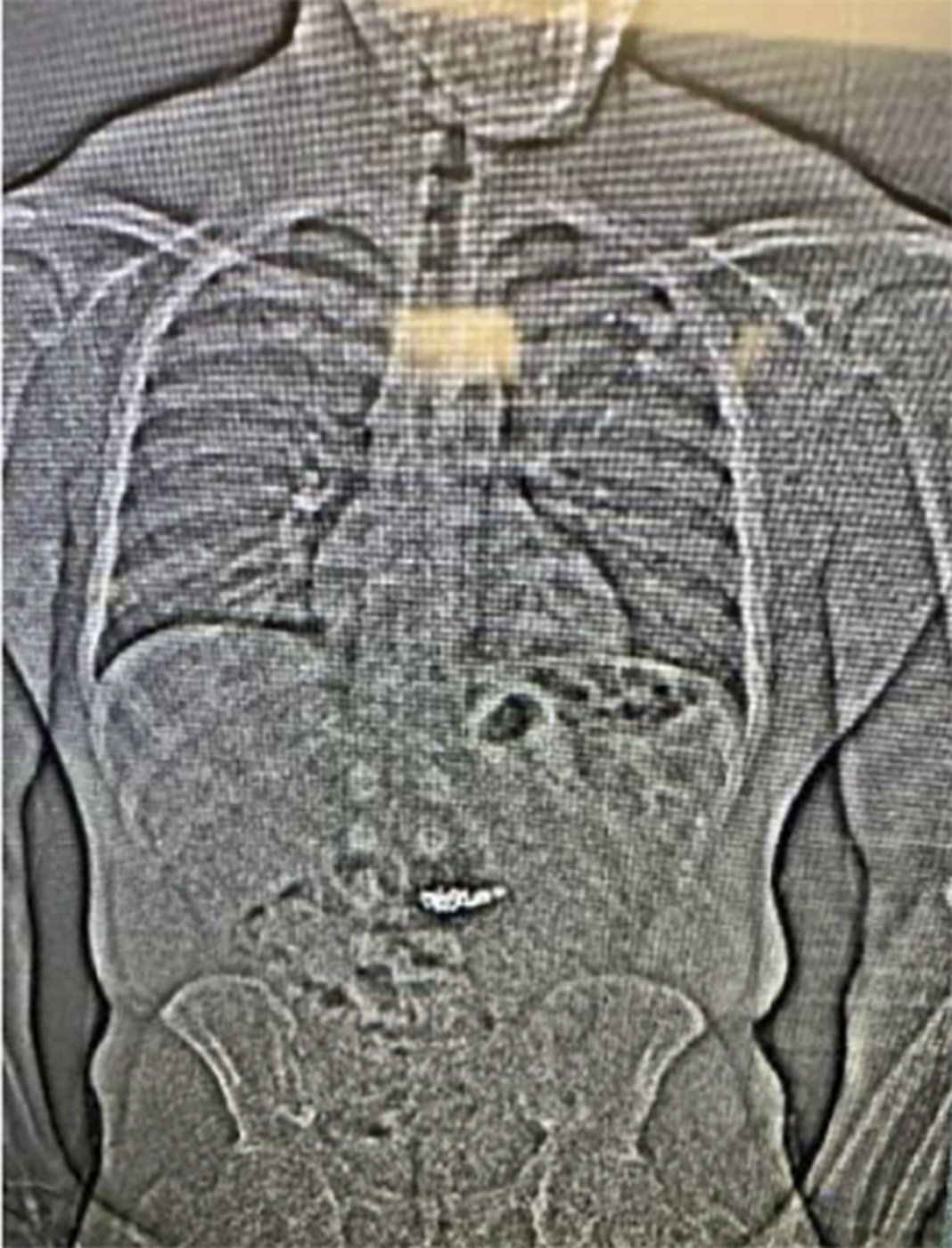Detectives recover 4 diamond earrings 2 weeks after suspect swallowed them during arrest | iNFOnews.ca Detectives recover 4 diamond earrings 2 weeks after suspect swallowed them during arrest | iNFOnews.ca