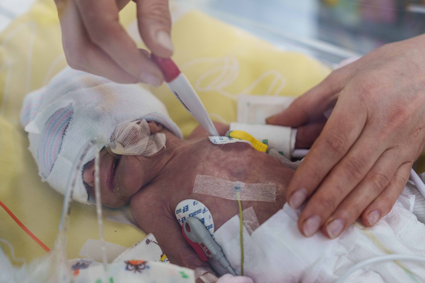As Ukraine fights off Russia's invasion, some regions see a rise in premature births | iNFOnews.ca As Ukraine fights off Russia's invasion, some regions see a rise in premature births | iNFOnews.ca